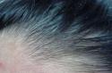 Линия роста волос на голове V образная линия роста волос на лбу